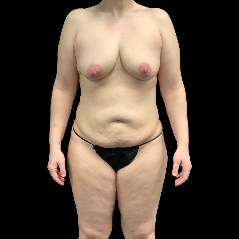 Extended Abdominoplasty 01