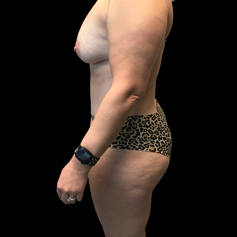 Extended Abdominoplasty 05