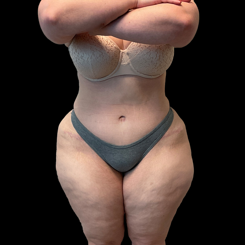 Extended Abdominoplasty 04