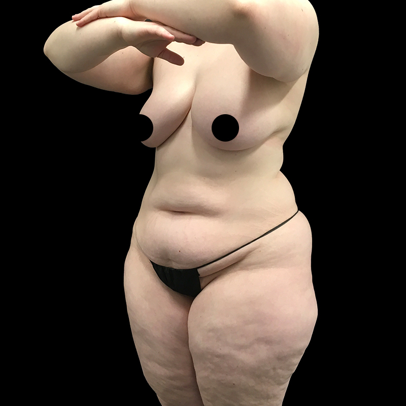 Extended Abdominoplasty 03