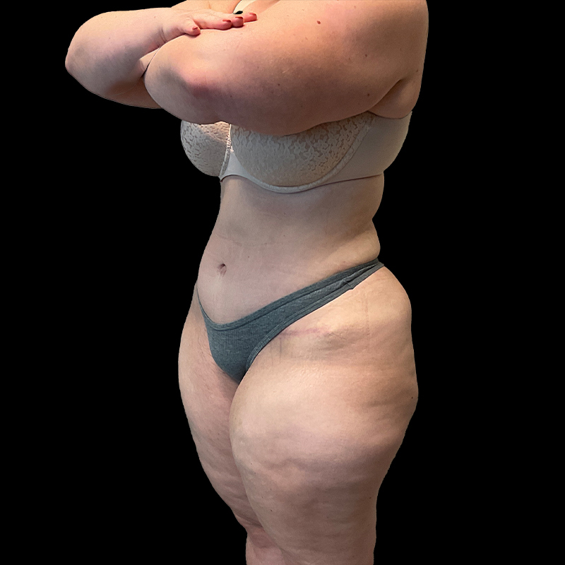 Extended Abdominoplasty 03