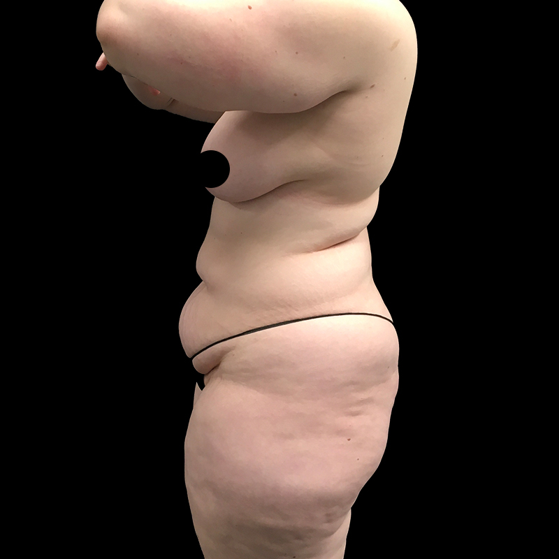 Extended Abdominoplasty 05