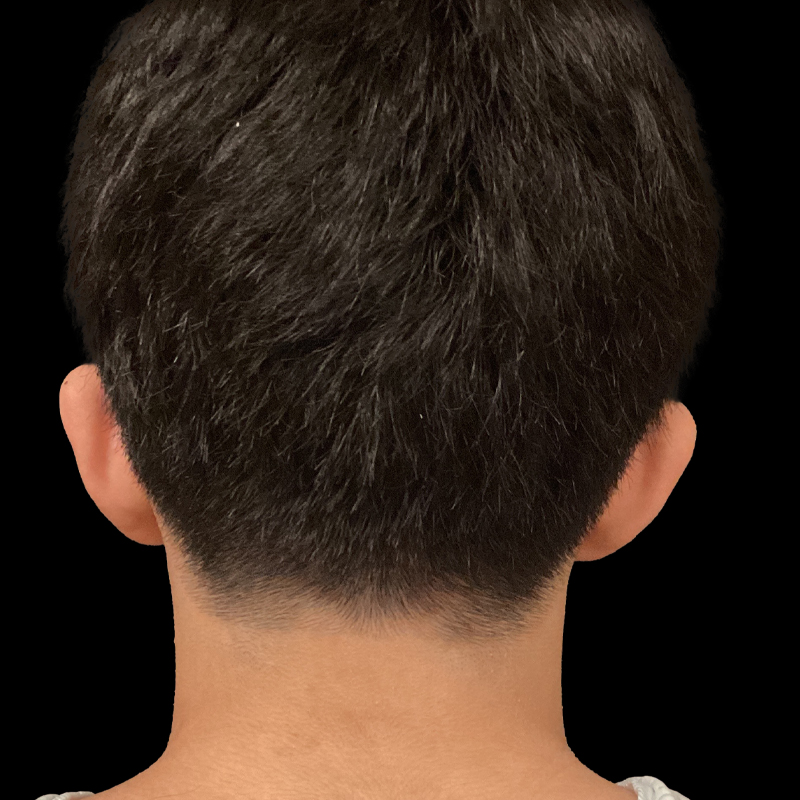 Extended Bilateral Otoplasty 05