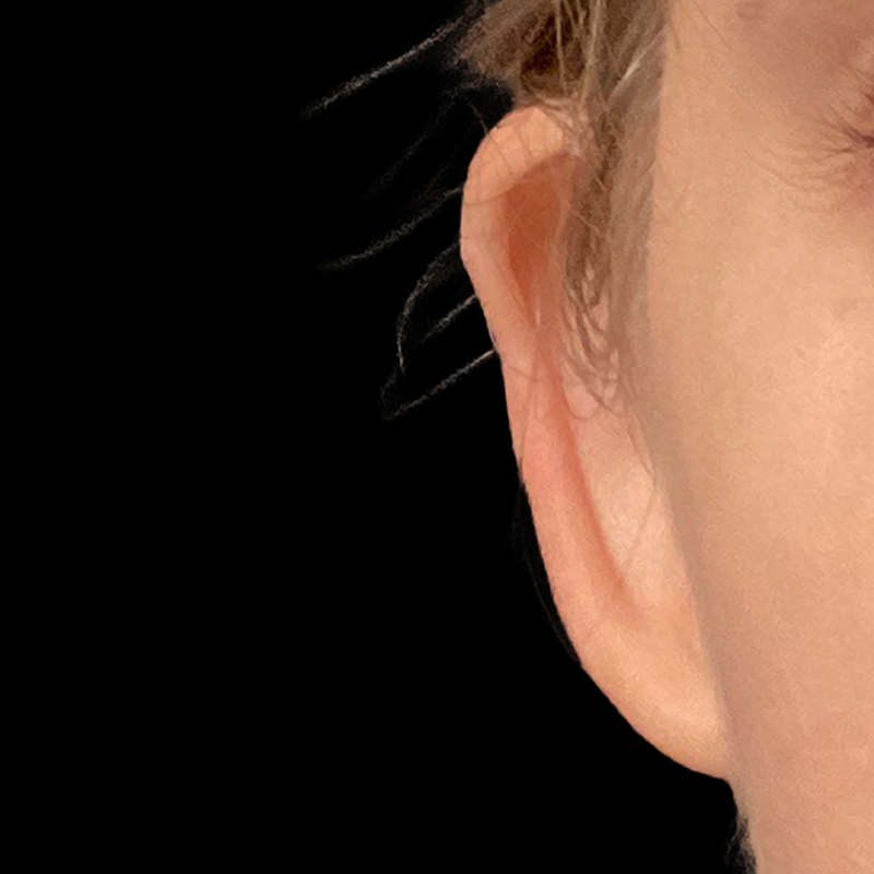Extended Bilateral Otoplasty 01