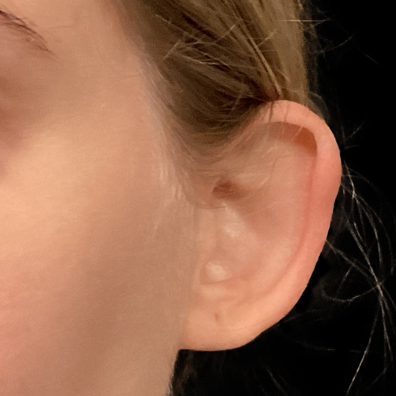 Extended Bilateral Otoplasty 03