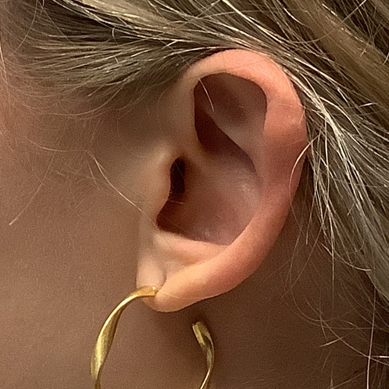 Extended Bilateral Otoplasty 05