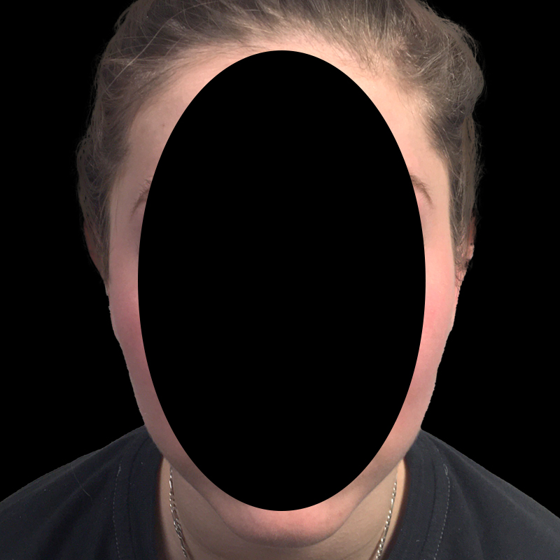 Extended Bilateral Otoplasty 03