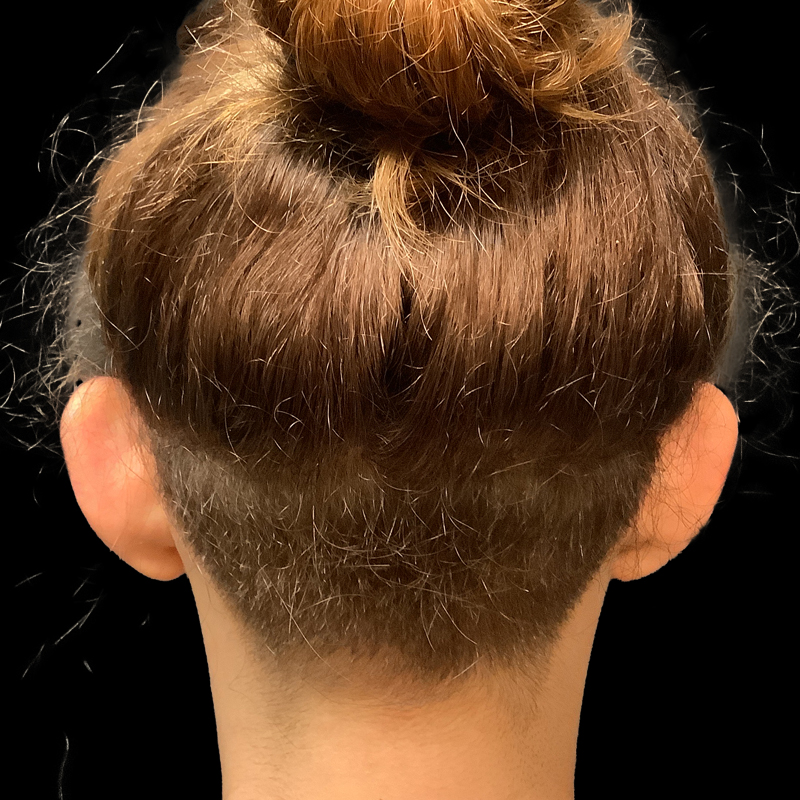 Extended Bilateral Otoplasty 03