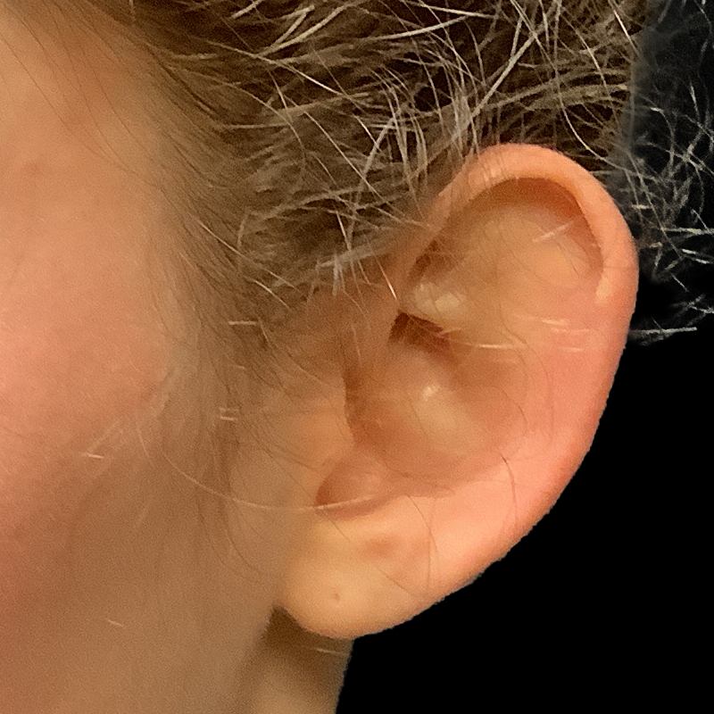 Extended Bilateral Otoplasty 05