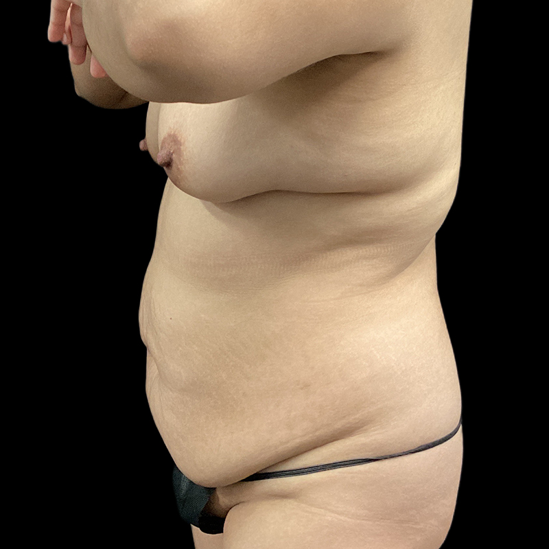 Extended Tummy Tuck 01