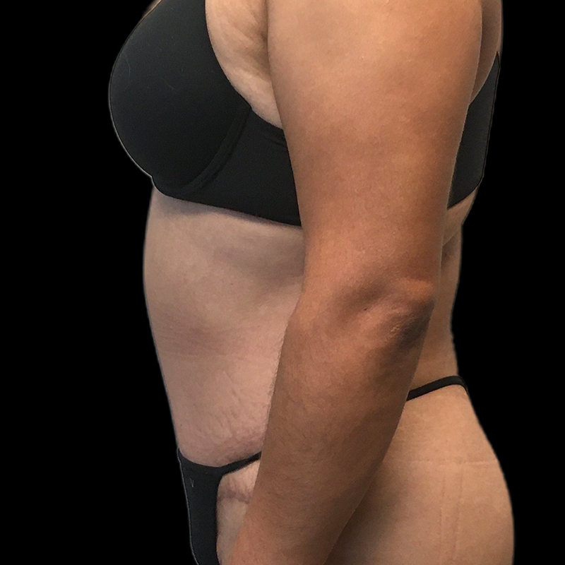 Extended Tummy Tuck 01