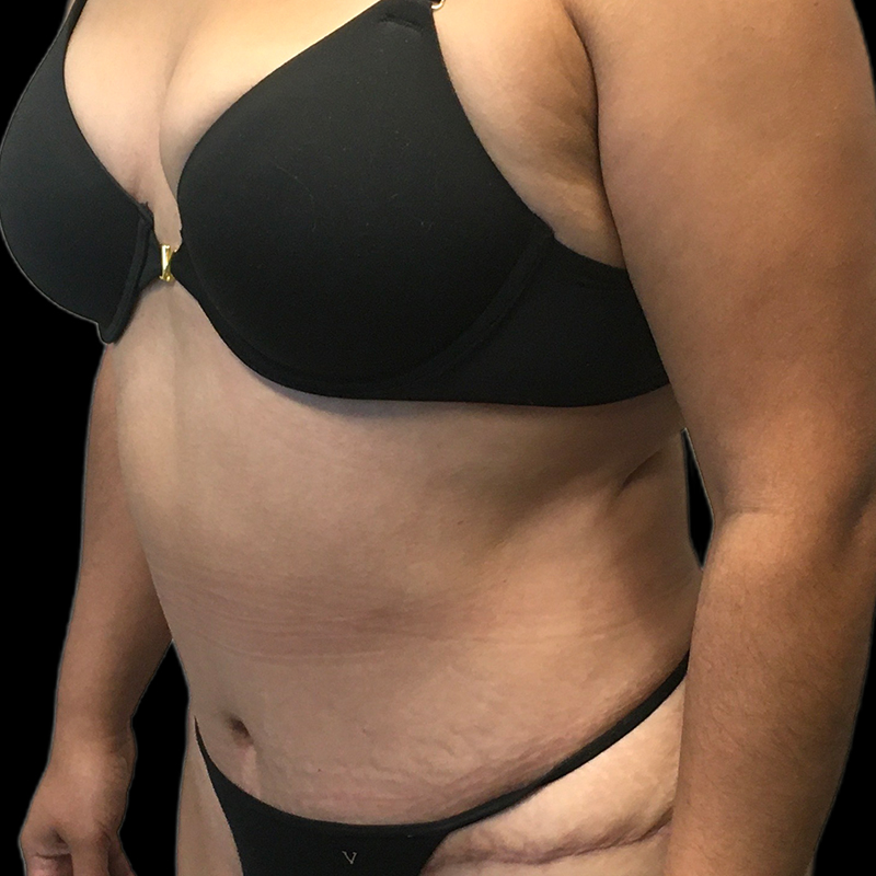 Extended Tummy Tuck 03