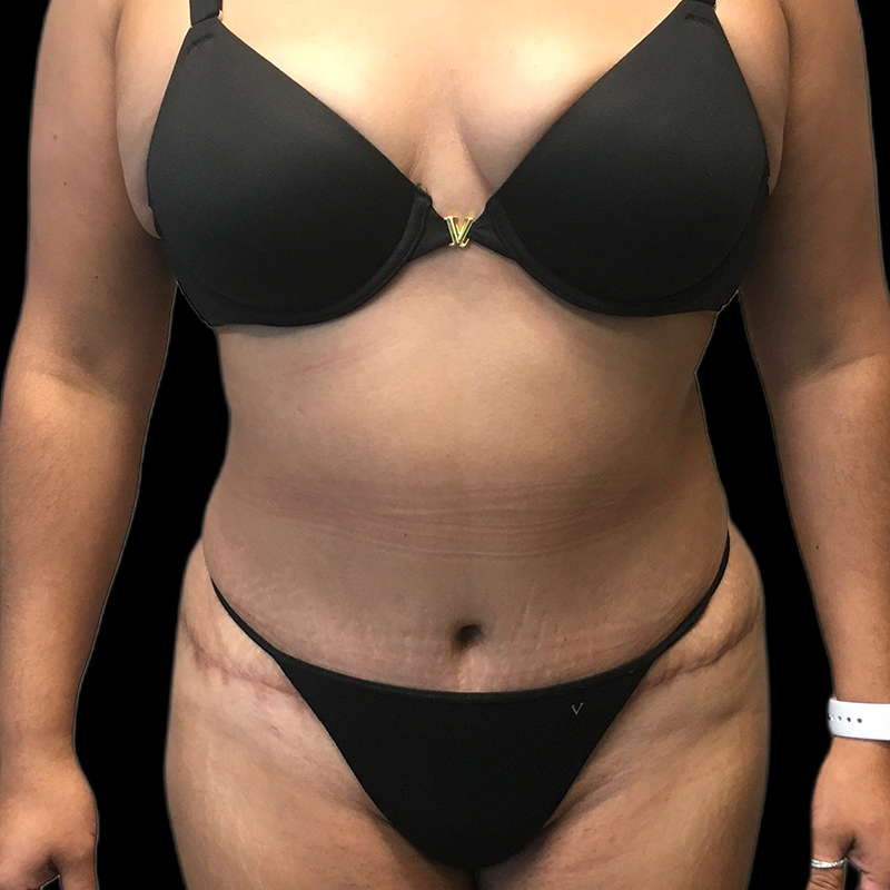 Extended Tummy Tuck 05
