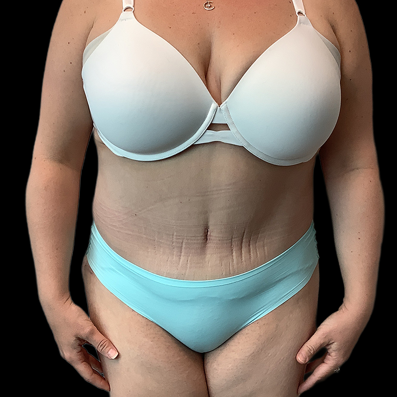Extended Tummy Tuck 02