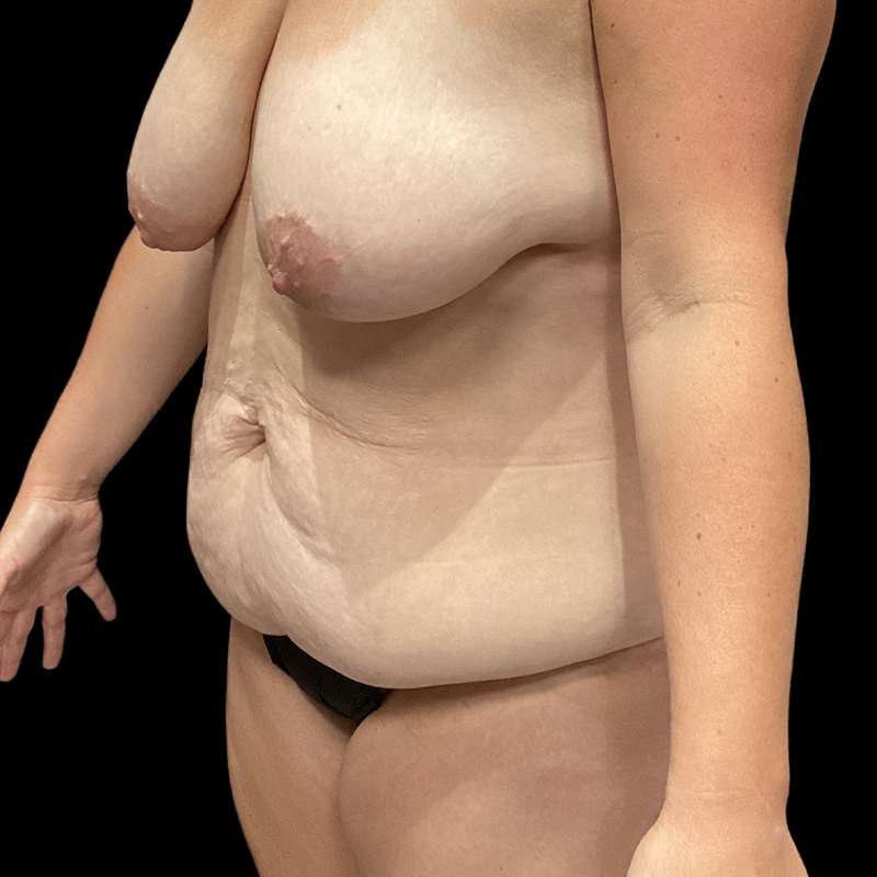 Extended Tummy Tuck 03