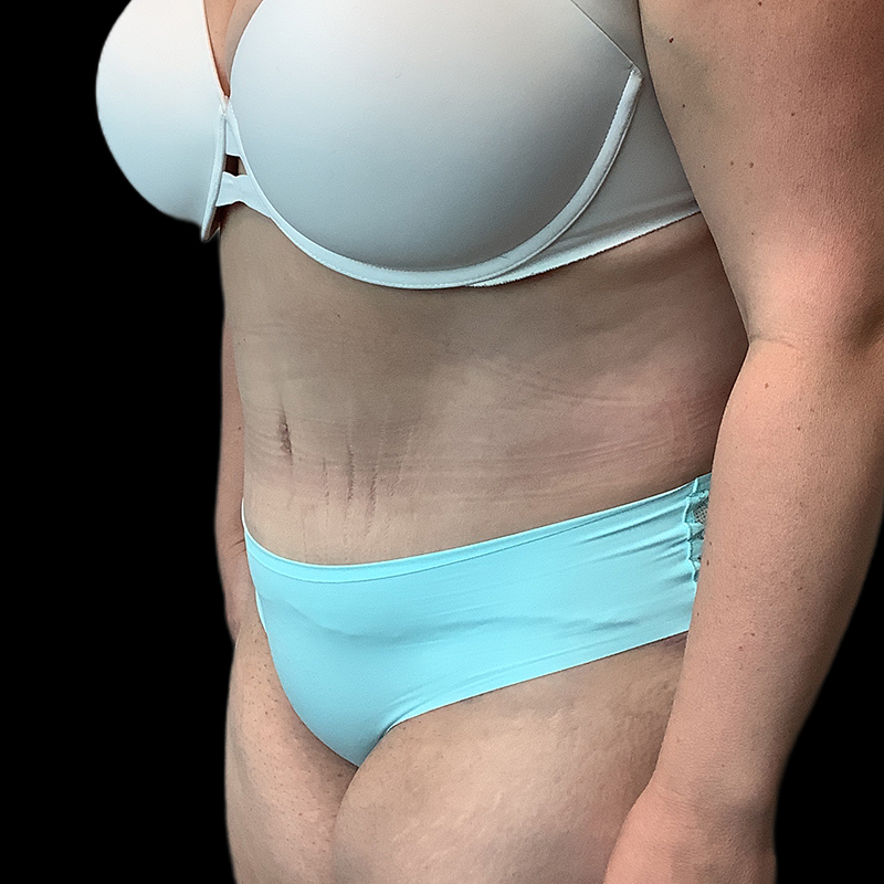 Extended Tummy Tuck 03