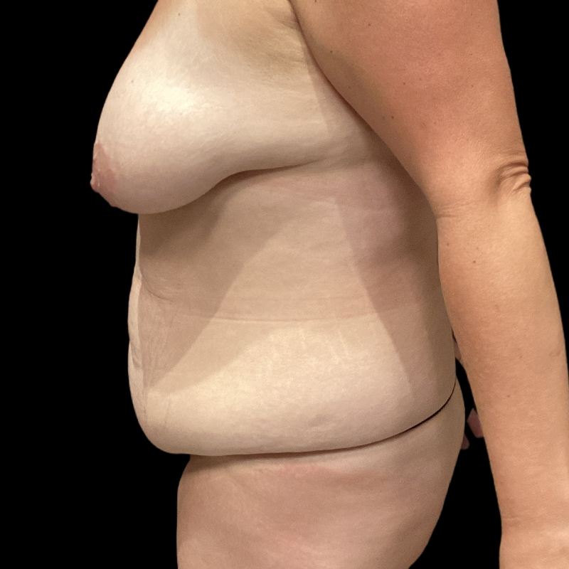 Extended Tummy Tuck 05