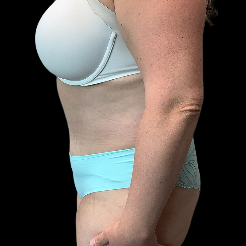 Extended Tummy Tuck 05