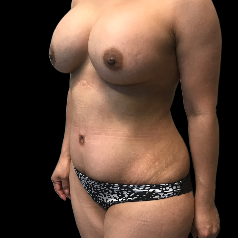 Extended Tummy Tuck 03