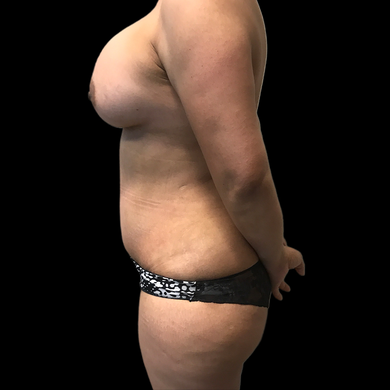 Extended Tummy Tuck 05