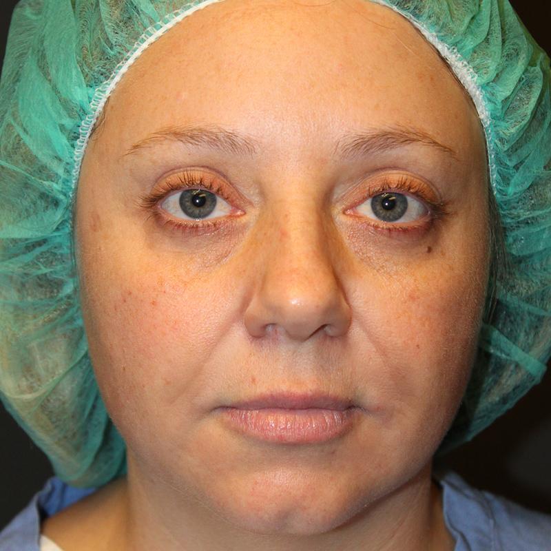 Facial Fat Transfer 01