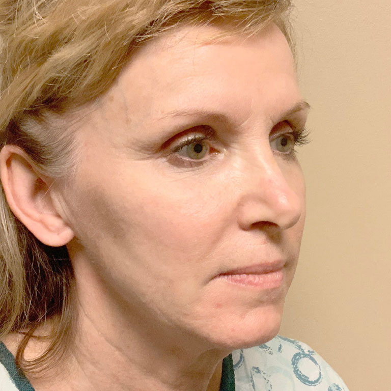 Facial Fat Transfer 05