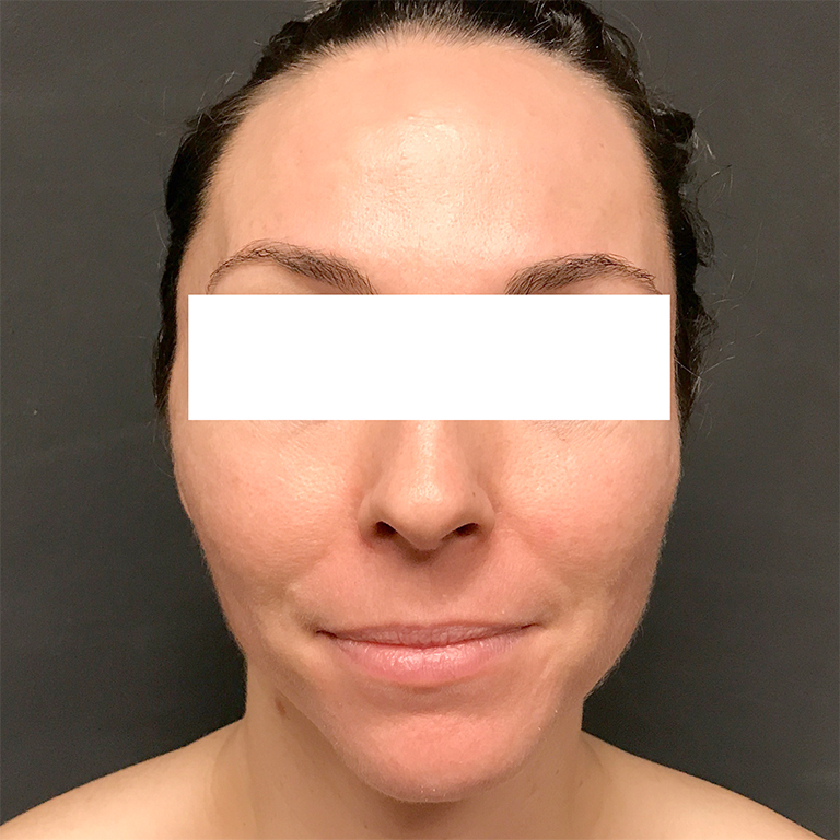 Facial Fat Transfer 01
