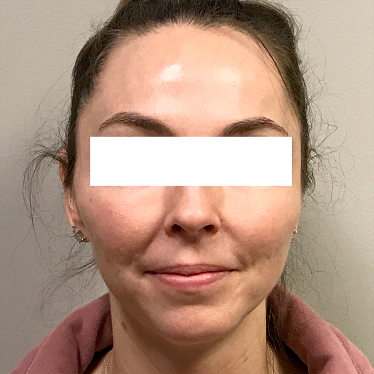 Facial Fat Transfer 03