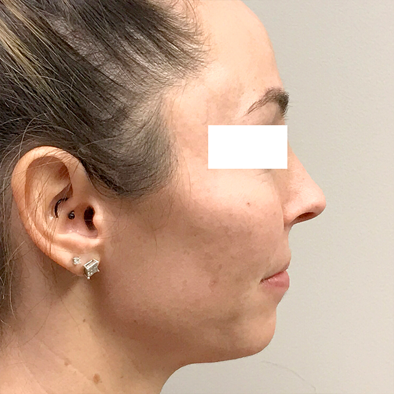 Facial Fat Transfer 03