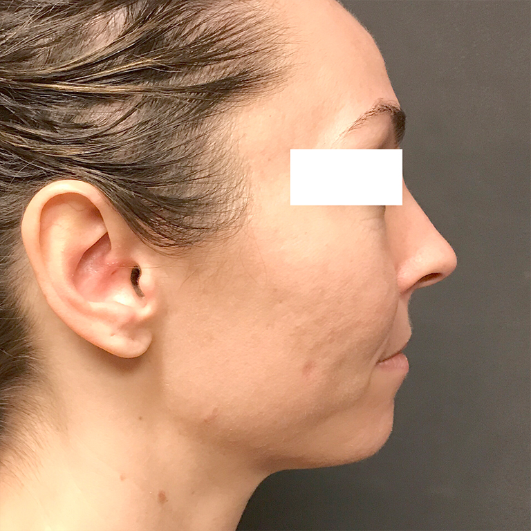 Facial Fat Transfer 03