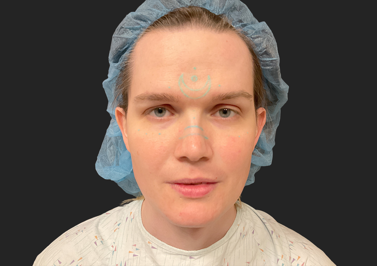 Facial Feminization 01