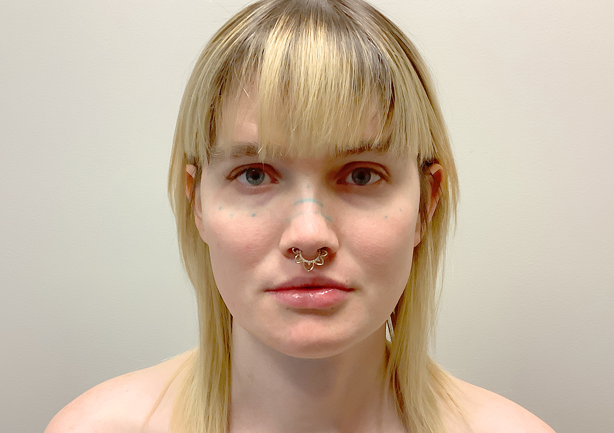 Facial Feminization 01