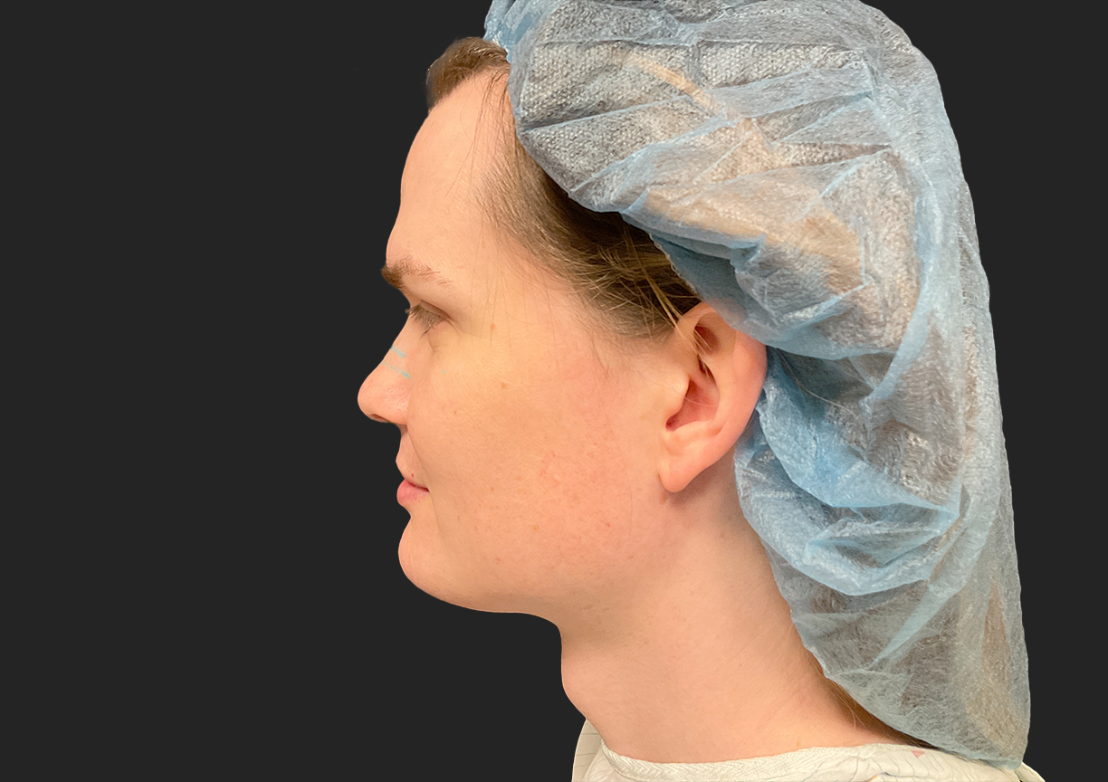 Facial Feminization 03