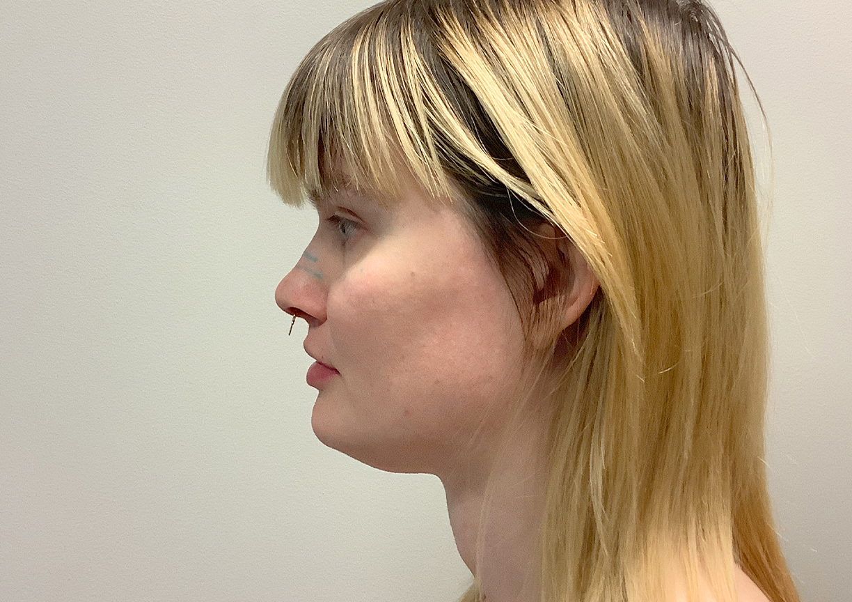 Facial Feminization 03