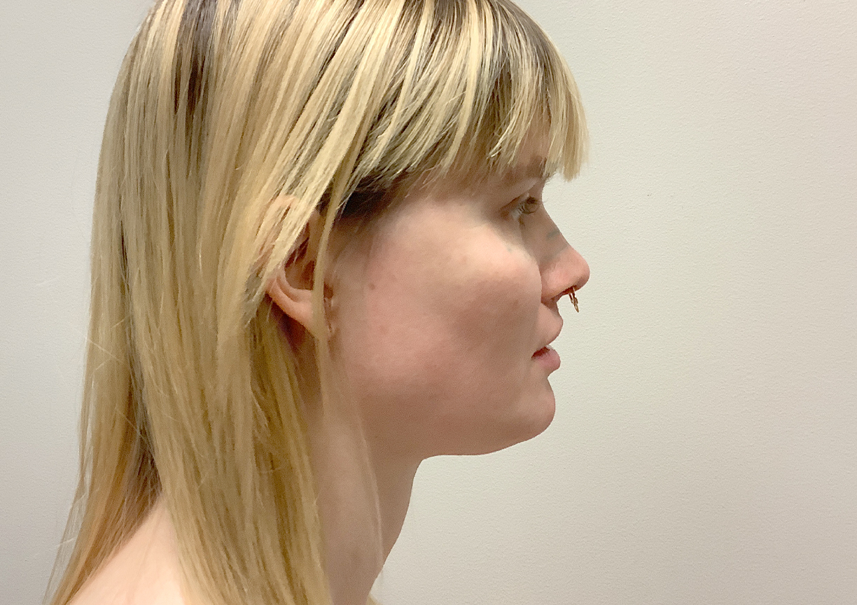 Facial Feminization 05