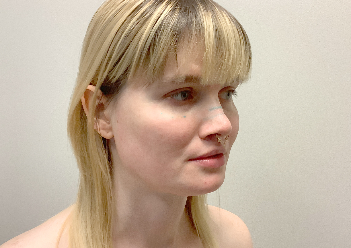 Facial Feminization 09