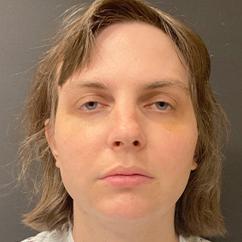 Facial Feminization 01