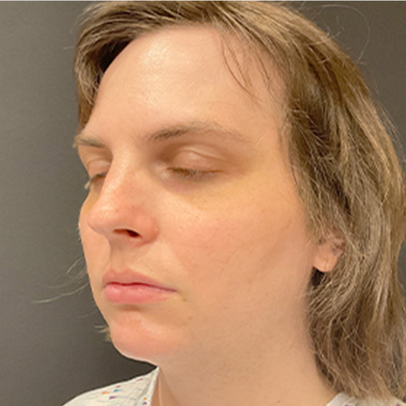 Facial Feminization 05