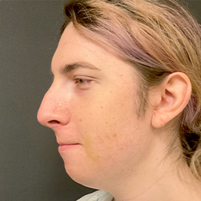 Facial Feminization 07