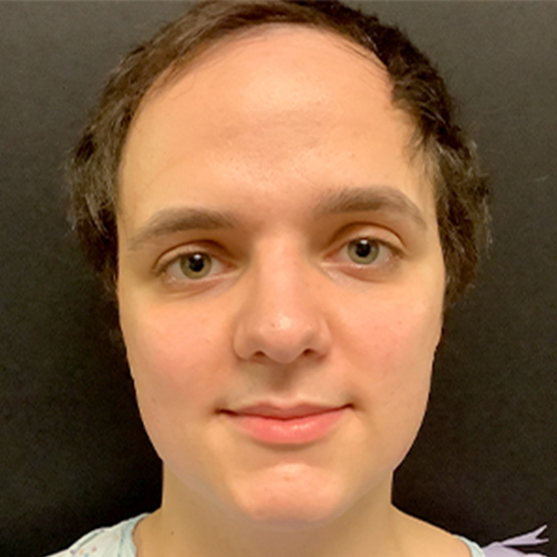 Facial Feminization 01