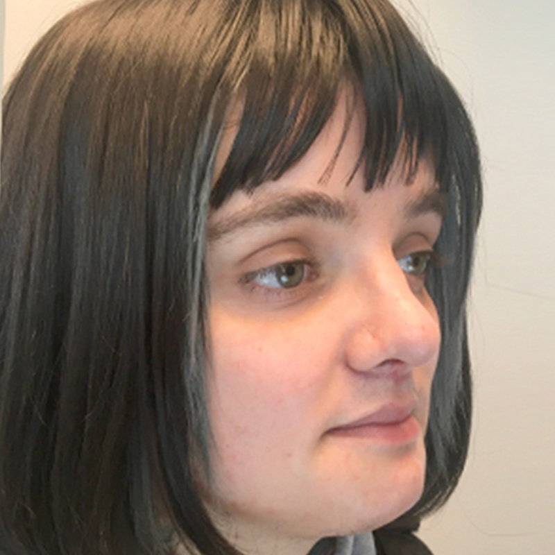 Facial Feminization 03