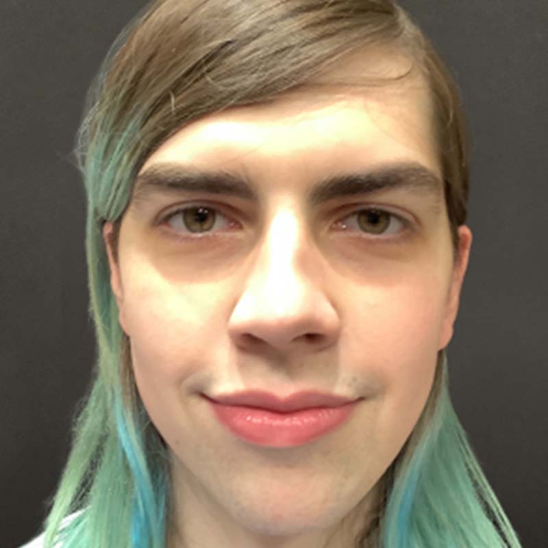 Facial Feminization 01