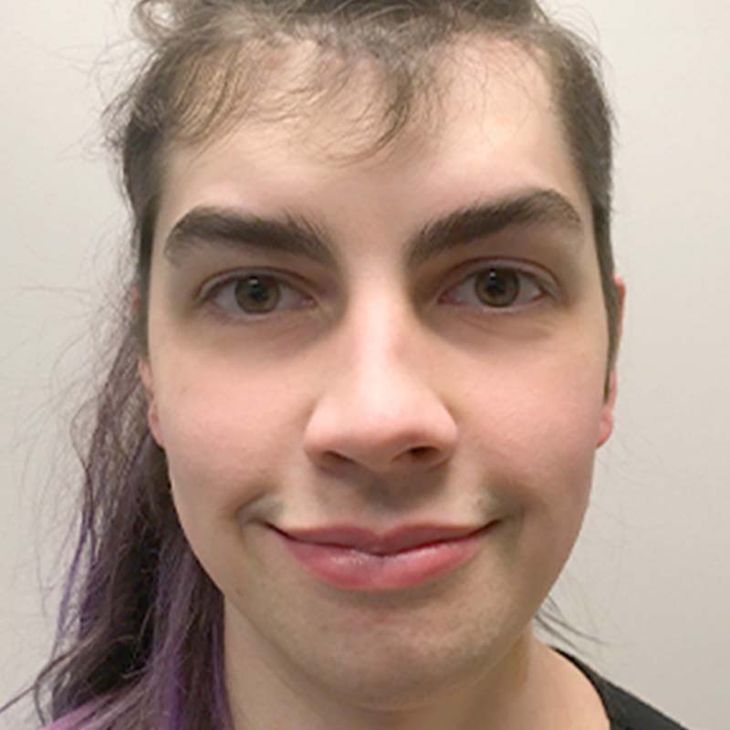 Facial Feminization 05