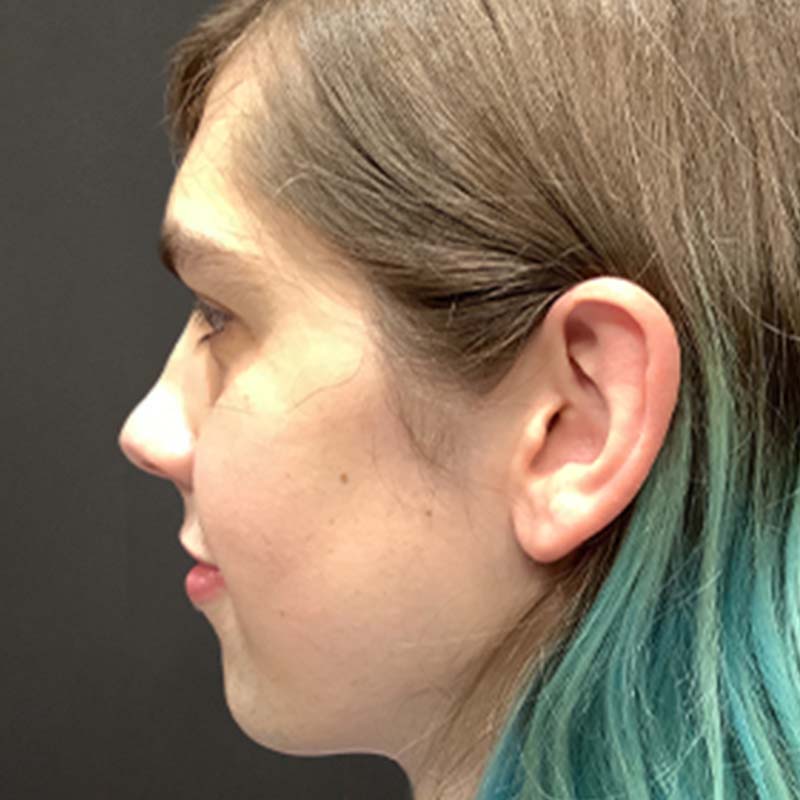 Facial Feminization 03