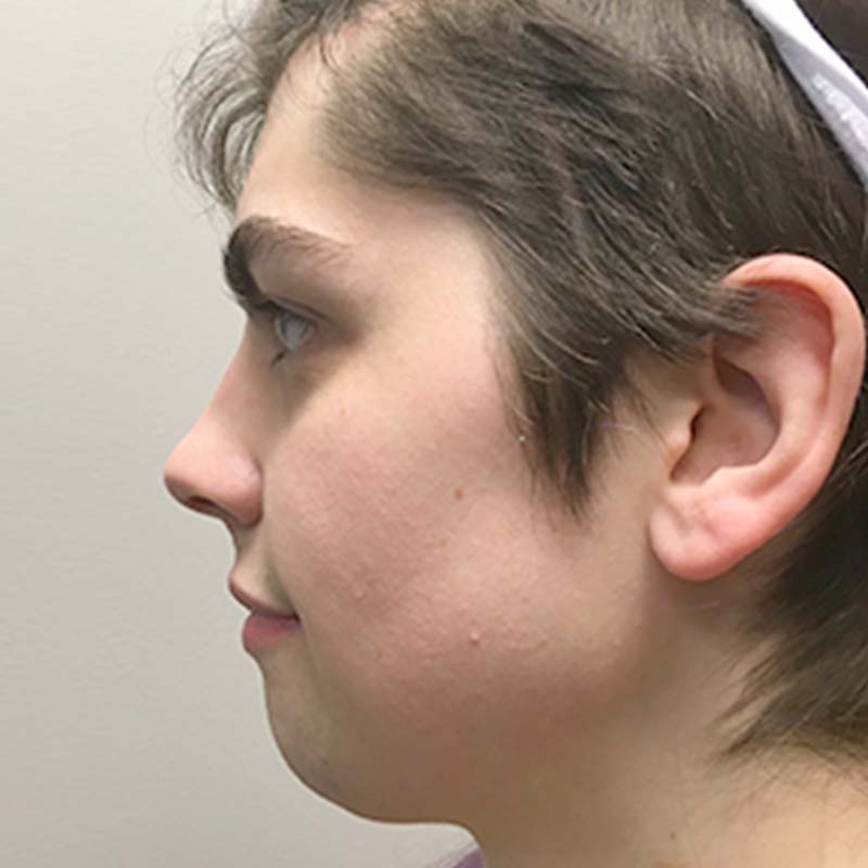 Facial Feminization 03