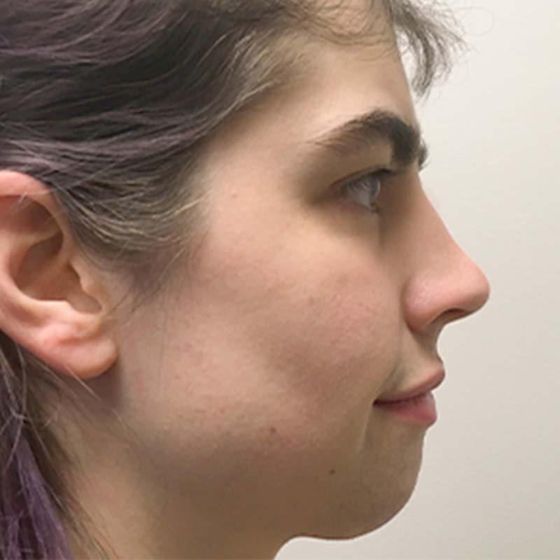 Facial Feminization 05