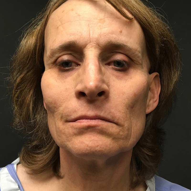 Facial Feminization 01
