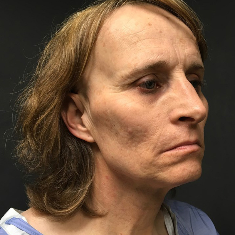 Facial Feminization 03