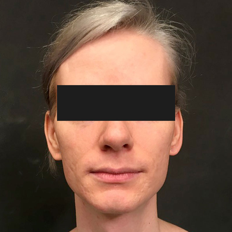 Facial Feminization 01
