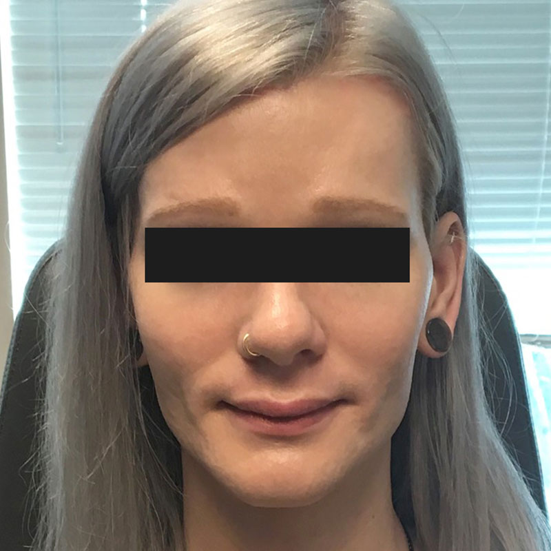 Facial Feminization 07